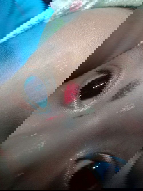 Apakah ini tanda stroberi (Hemangioma)?