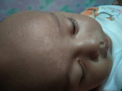 Cara ngilangain panu bayi 4 bln.