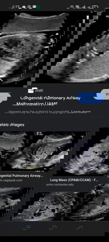 Multiple septated cyst@CCAM