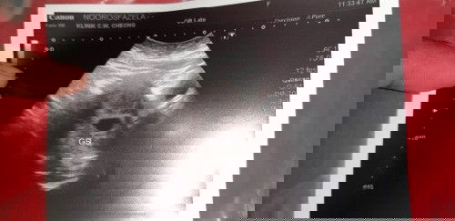 Alhamdulilah penantian 15tahun...first baby harap2 kekal..mummy2 doakan sy ya kuat.. 5week++