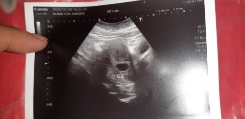 Alhamdulilah penantian 15tahun...first baby harap2 kekal..mummy2 doakan sy ya kuat.. 5week++