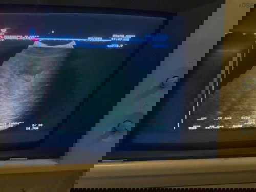 เจ็บท้องจิ๊ดมากขณะเอี้ยวตัว