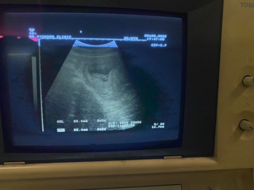 เจ็บท้องจิ๊ดมากขณะเอี้ยวตัว