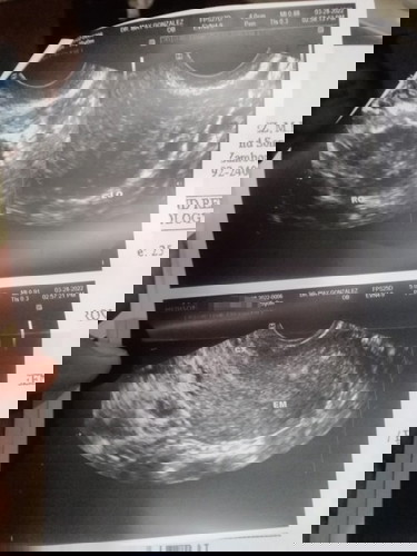 3mos delayed, lumalaki ang tiyan, can feel the symptoms, ALL NEGATIVE 😢