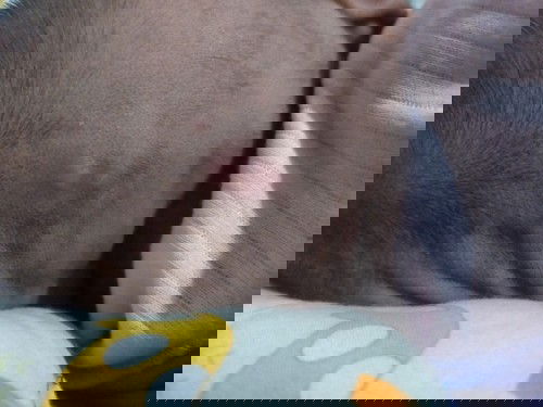 Bayi 2bulan bisul dikepala habis imunisasi bcg