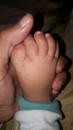 bintil(lenting) berair