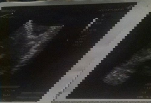 hPHT sm hasil USG berbeda🤔