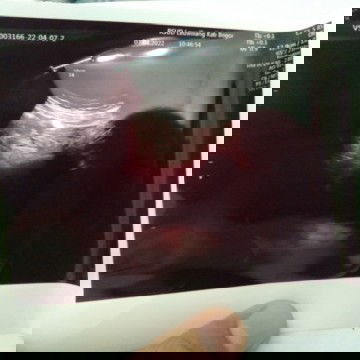 Usg 6 week setelah 3bulan menikah