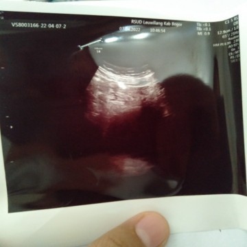 Usg 6 week setelah 3bulan menikah