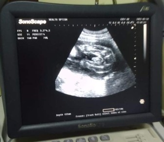 BABY BOY OR BABY GIRL ?