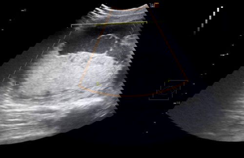 มีใครเคยเป็นก้อนซีสต์ขณะตั้งครรภ์มั้ยคะ