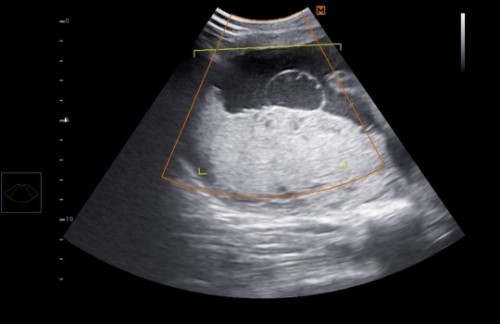 มีใครเคยเป็นก้อนซีสต์ขณะตั้งครรภ์มั้ยคะ