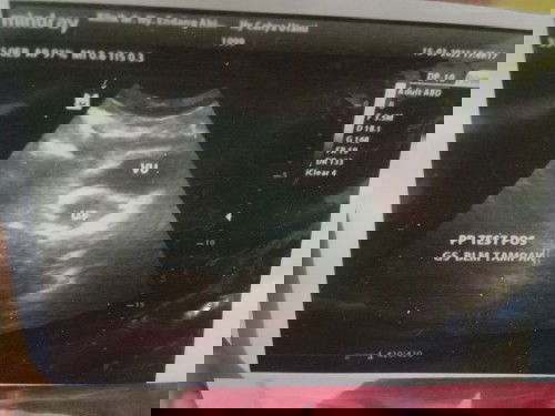 Usg 5w belum terlihat