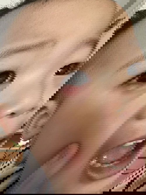 Semacam bisul di bawah mata