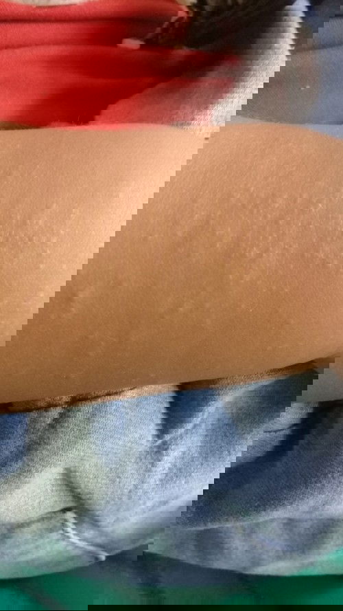 Bintik seperti telur ikan