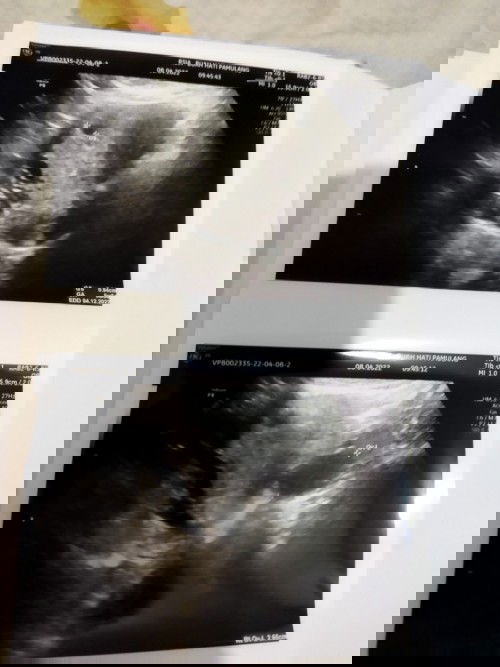 Hamil berdampingan dengan kista