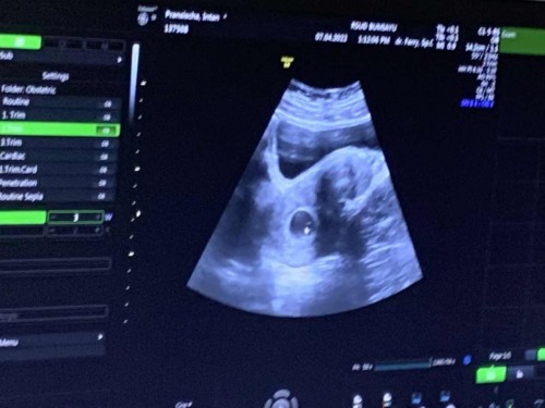 Usia USG sama Usia hitungan manual kok beda? Yang dijadikan patokan yang mana