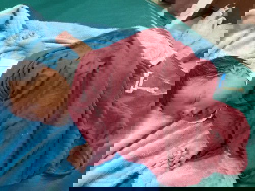 Bengkak pada leher bayi