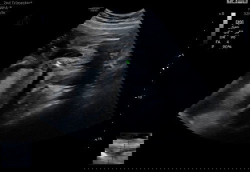 Mohon pendapat..pada pandangan ibu2 semua ini boy atau girl..sbb x phm nk tgk😅