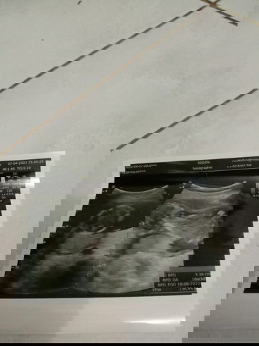 Saya usia kandungan 16w kmrin usg ternya sungsang gpp ?cara ngatasinnya gimana ya dok?