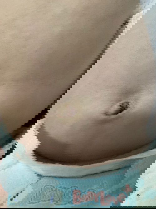 สะดือแบบนี้ปกติไหมคะ