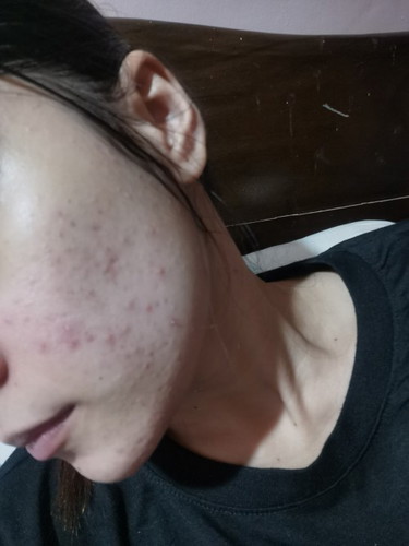 Acne problem