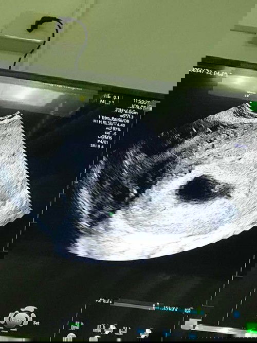 ซาวแล้วไม่เจอน้องเลยค่ะ 7w5d