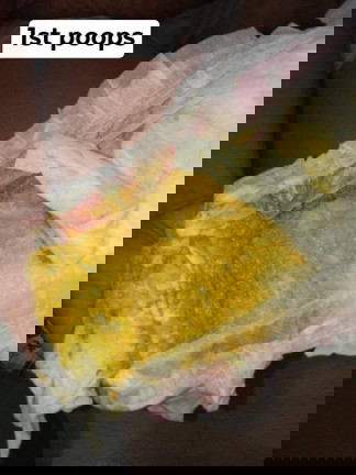 Pagtatae ni baby 2months old