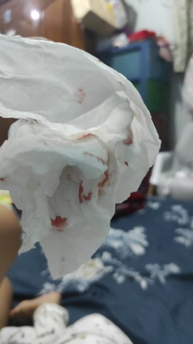 Baby 10 bulan mimisan