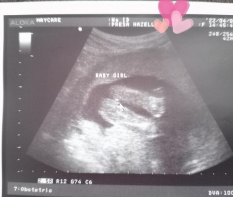 19 weeks gender scan