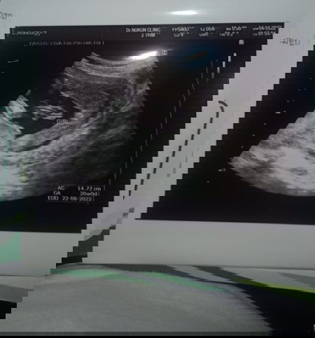 20wแล้วคุณหมอบอกว่าเด็กผู้หญิง