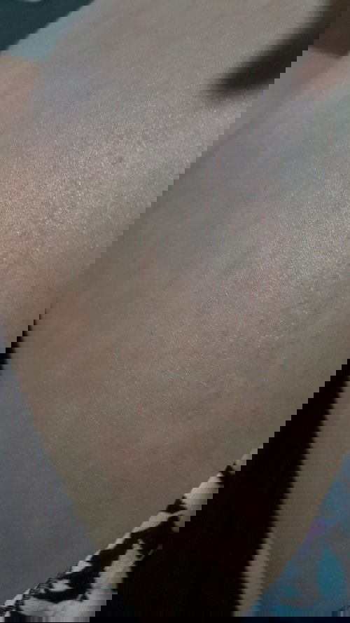 ท้อง 24wk มีผื่นแดงขึ้นอันตรายมั้ยคะ