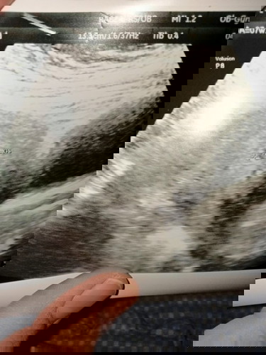 สอบถามค่ะ มีใครเคยอายุครรภ์กับ ถุงตั้งครรภ์ไม่สมดุลกันบ้างไหมคะ