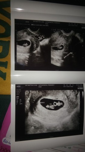 ไข่2ใบนอนยุในท้อง