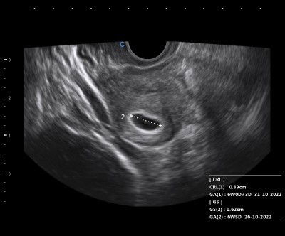 Usg melihat kantong janin