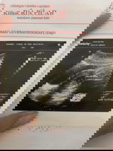 Bedrest Total kehamilan 7minggu3hari