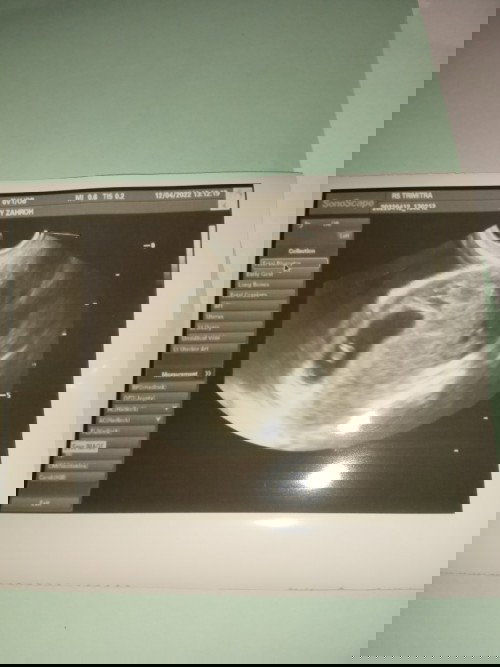 Taqdir Allah pasti yang terbaik, Penantian 5 tahun