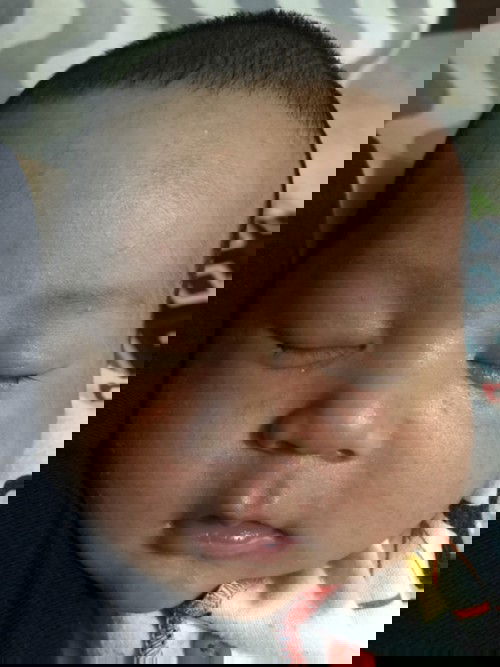 Menghilangkan kemerahan /bruntusan