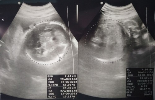 Sering keram dan kontraksi palsu