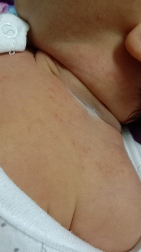 น้องอายุได้14วันแล้วมีผื่นขึ้นที่คจะเป็นอะไรไหมค่ะ