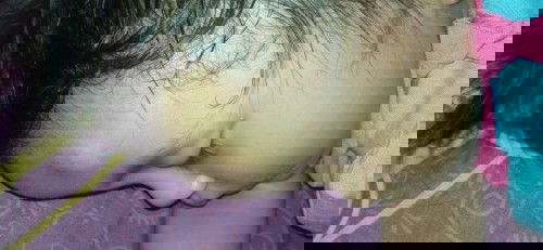 Benjolan seperti darah beku di jidat anak