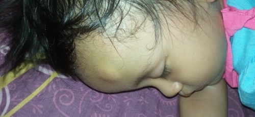 Benjolan seperti darah beku di jidat anak