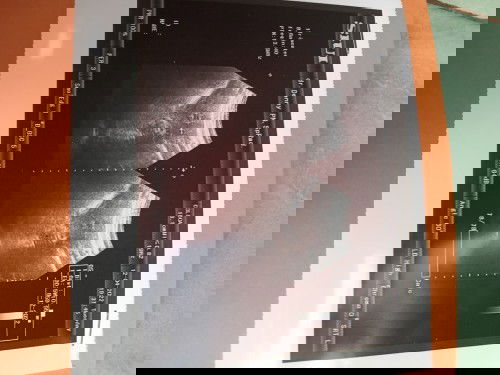 Hpl bidan beda sama usg