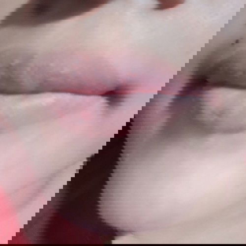 Bibir bengkak & bentol* kecil