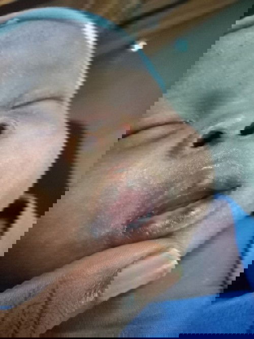 My 1 month old baby's lower lip is getting black