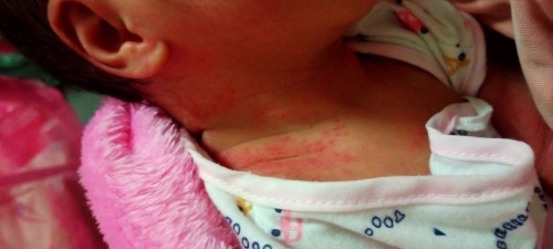 ผื่นร้อนน้องขี้ร้อน