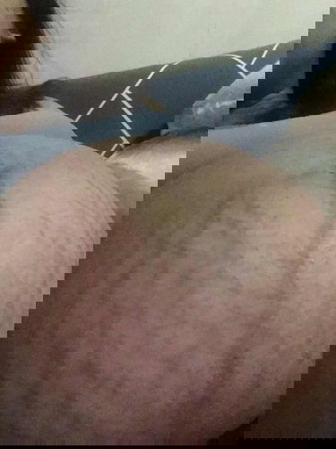 ท้องแตกลายคันมาก