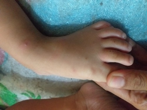 Obat oles untuk anak yg di gigit semut