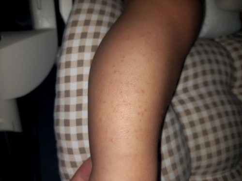 Heat rash?