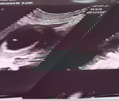 8 MINGGU . 4 KALI KELUAR SPOTTING , DOKTOR SURUH CUCI